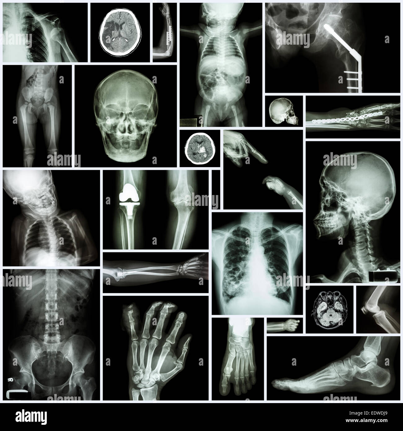 Kollektion x-ray "Mehrere Teil des Menschen", "Orthopädie" und "Mehrere Krankheit" (Fraktur, Luxation, Osteoarthr der Schulter Stockfoto