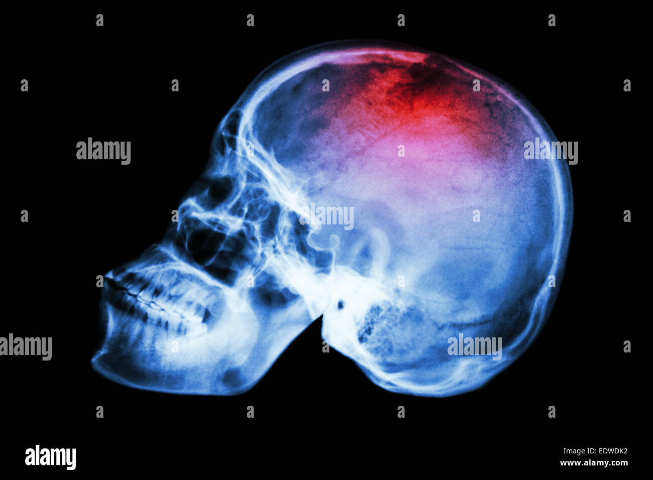 Röntgen Schädel seitlich mit "Schlaganfall" Stockfoto