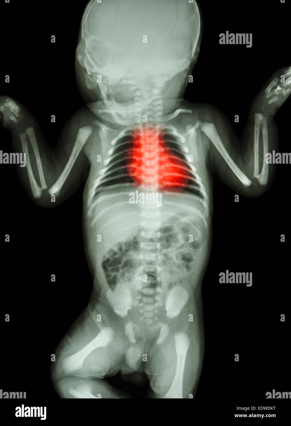 X-ray kindlichen Körper mit Herz-Kreislauferkrankungen Stockfoto