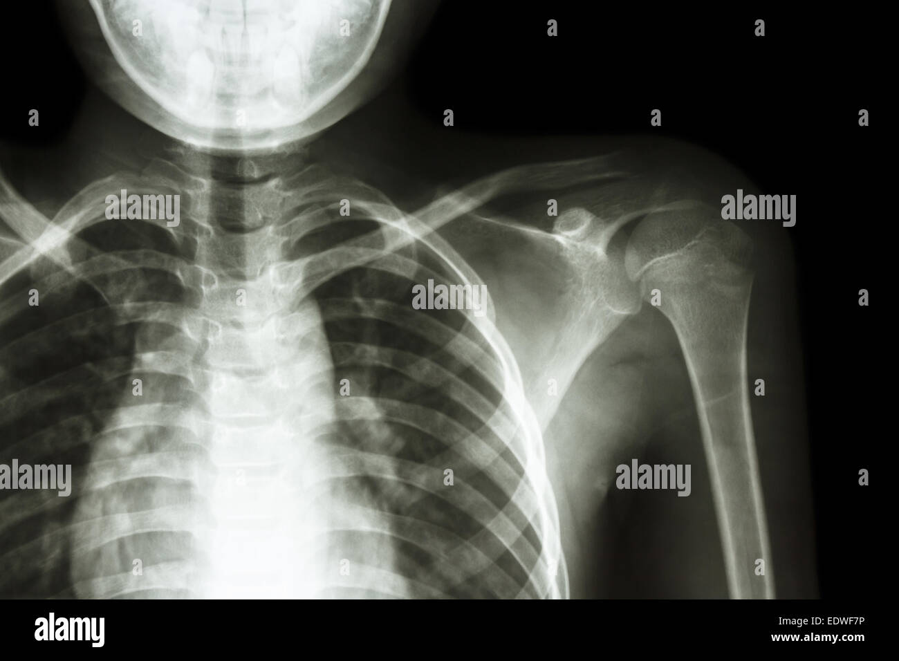 Film x-ray linke Schulter Stockfoto