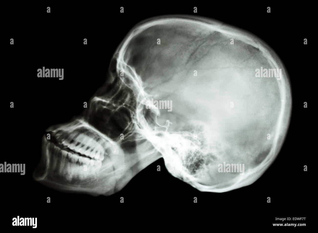 Film Röntgen Schädel seitlich des Asiaten (Thais) Stockfoto