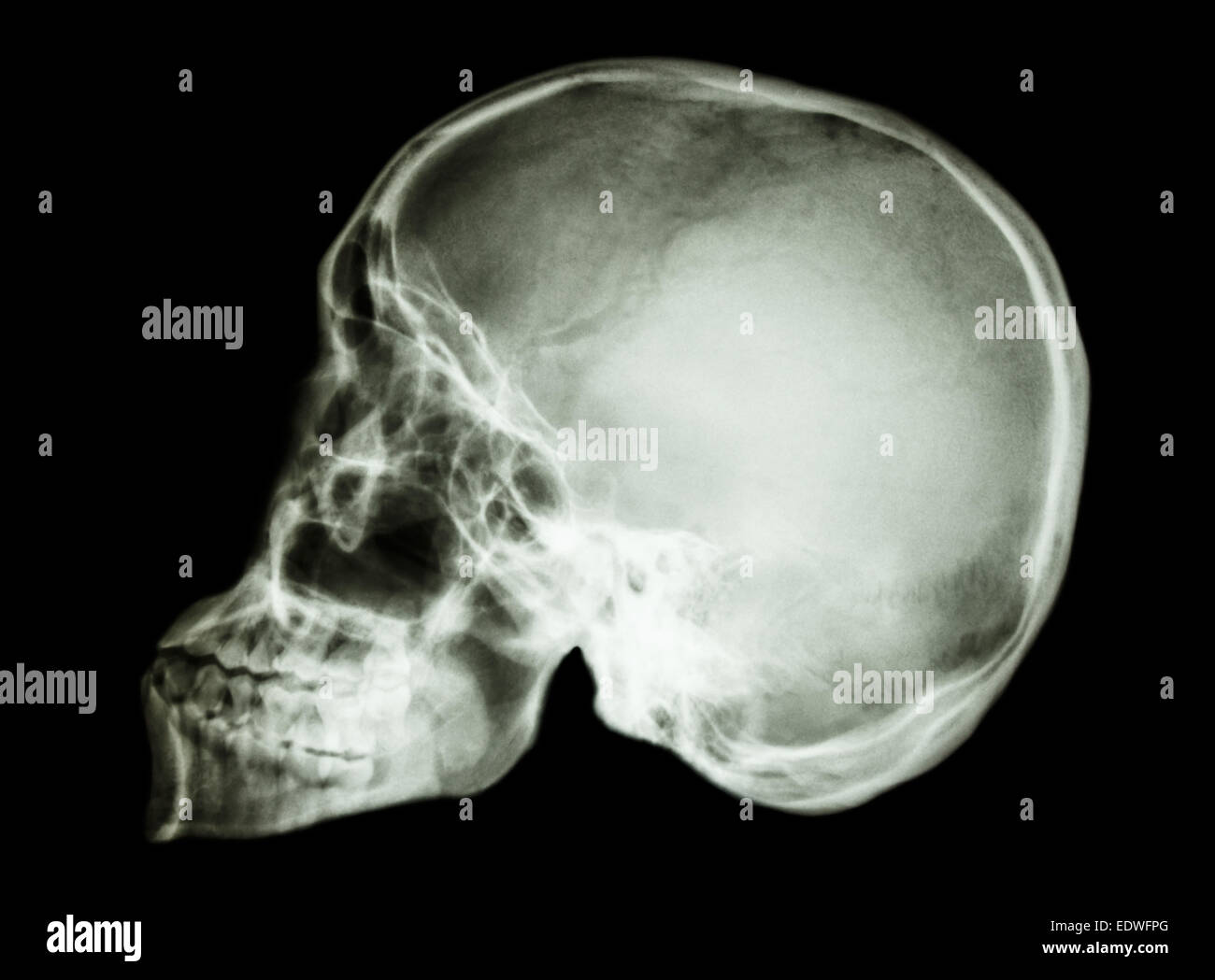 Film Röntgen Schädel seitlich: zeigen normale menschliche Schädel Stockfoto