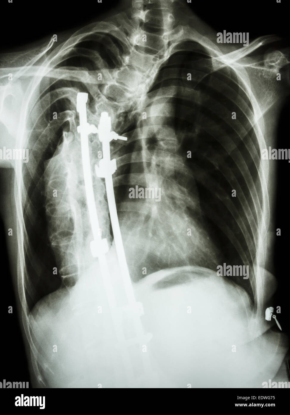 Skoliose-Patienten wurde operiert und interne festgesetzt Brustwirbelsäule Stockfoto