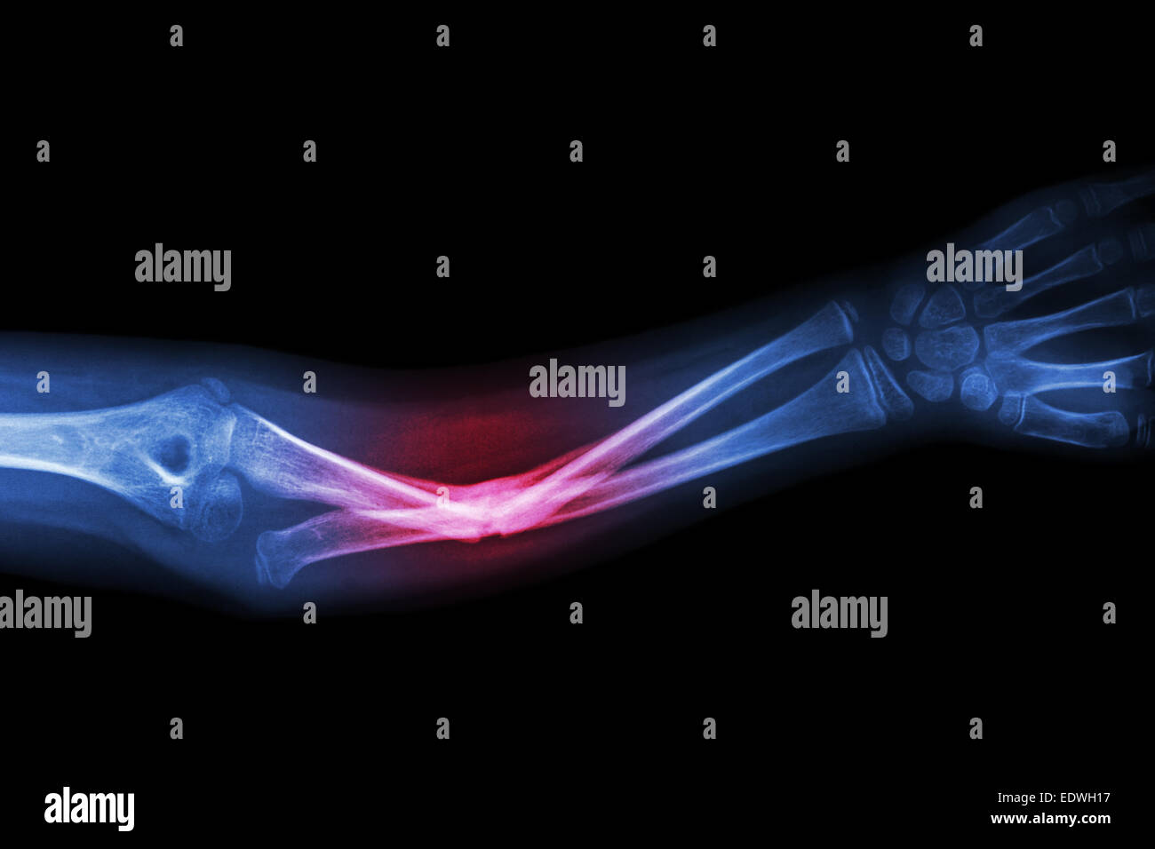X-ray Fraktur ulnaren Knochen (Unterarm-Knochen) Stockfoto