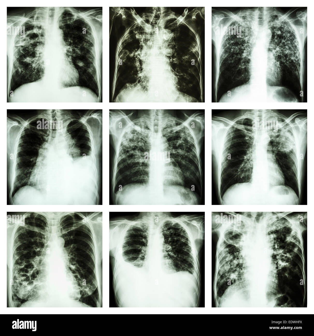 Sammlung von Lungenerkrankungen (Lungentuberkulose, Pleuraerguss, Bronchiektasen) Stockfoto