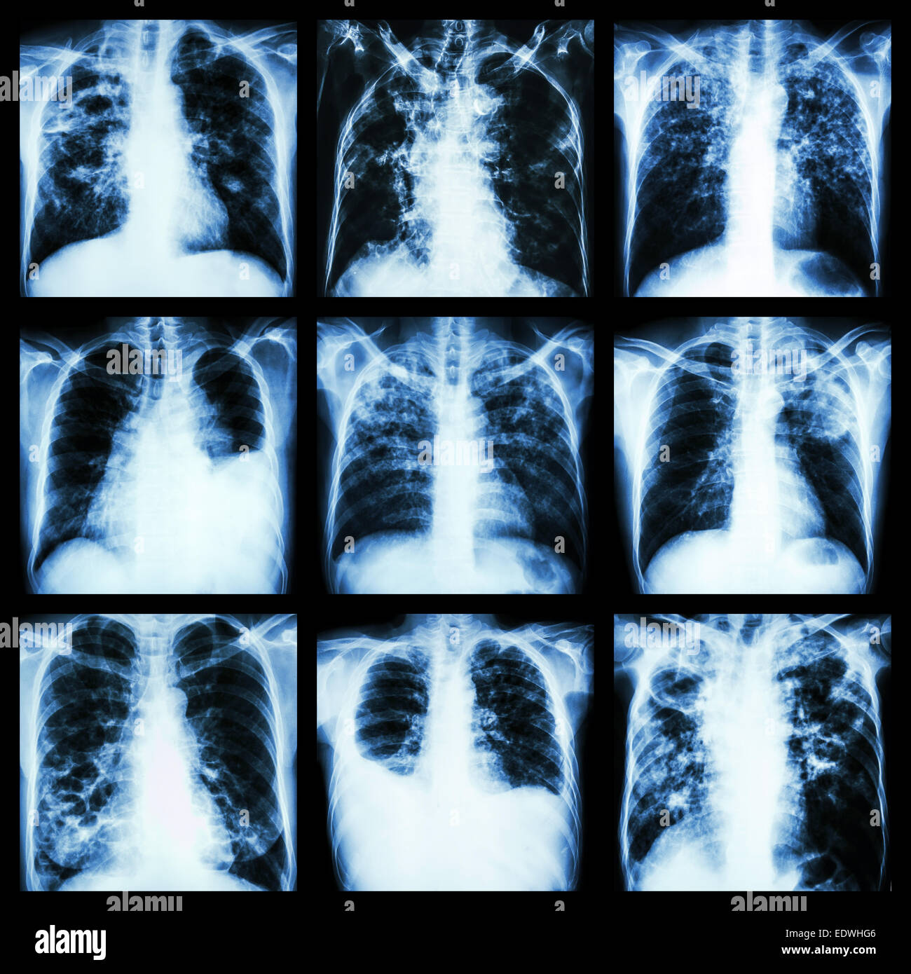 Sammlung von Lungenerkrankungen (Lungentuberkulose, Pleuraerguss, Bronchiektasen) Stockfoto