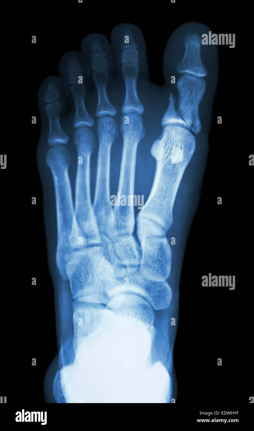 x-ray Filmschau Fraktur proximale Phalanx an ersten Zehe Stockfoto