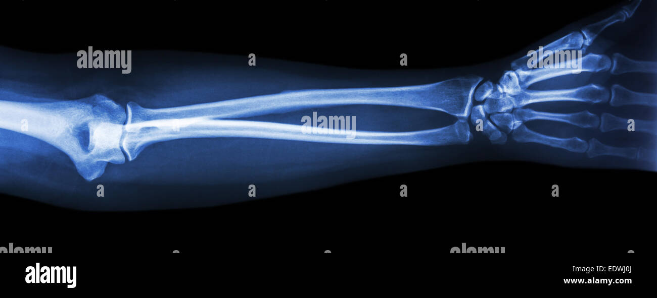 Film Röntgen Unterarm AP(antero-posterior) Stockfoto