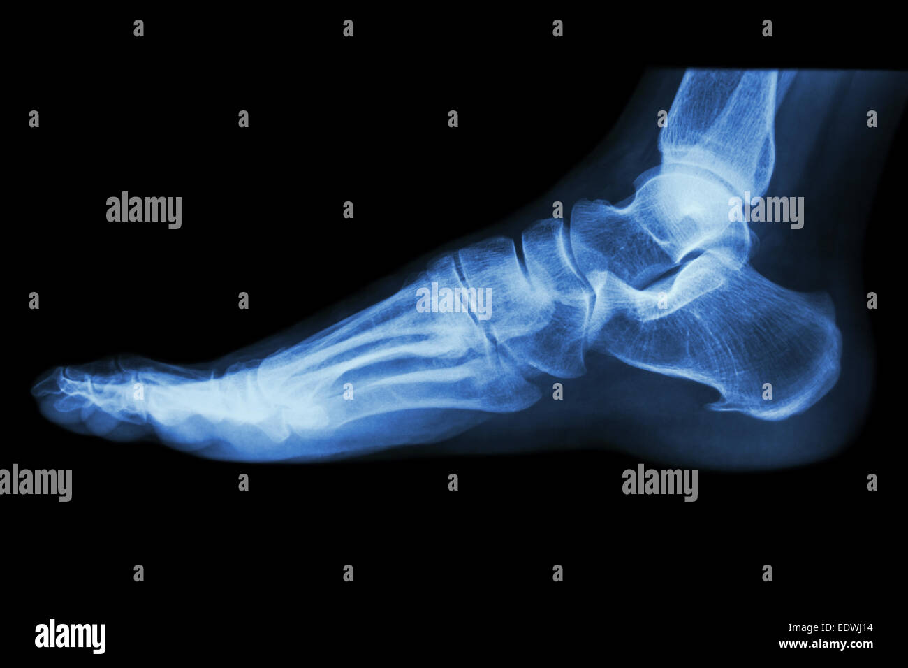 X-ray normal menschlichen Fuß seitlich Stockfoto