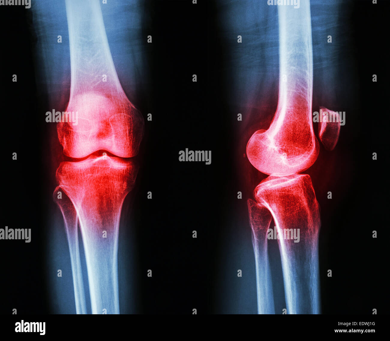 Film Röntgen Knie AP/seitlich: Arthrose Knie (Entzündung am Knie) Stockfoto