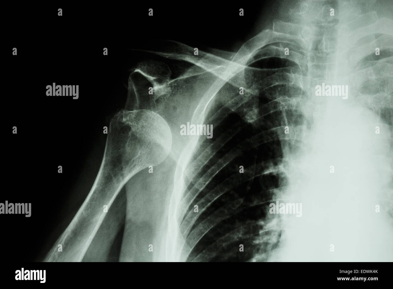 X-ray anterioren Schulterluxation Stockfoto