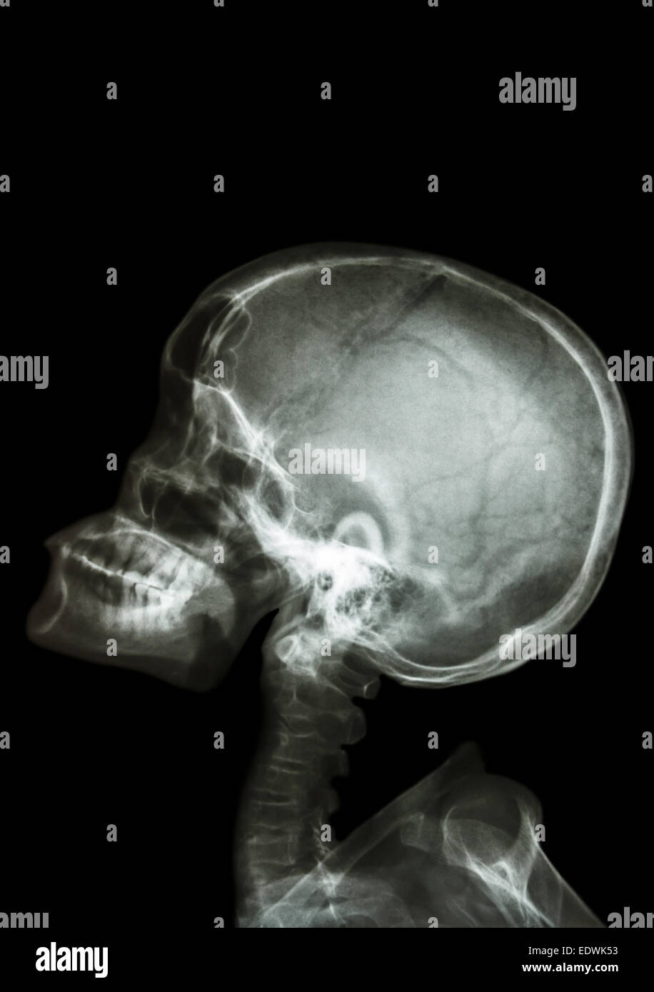 X-ray asiatischen Kind nachschlagen und leeren Bereich an Oberseite Stockfoto
