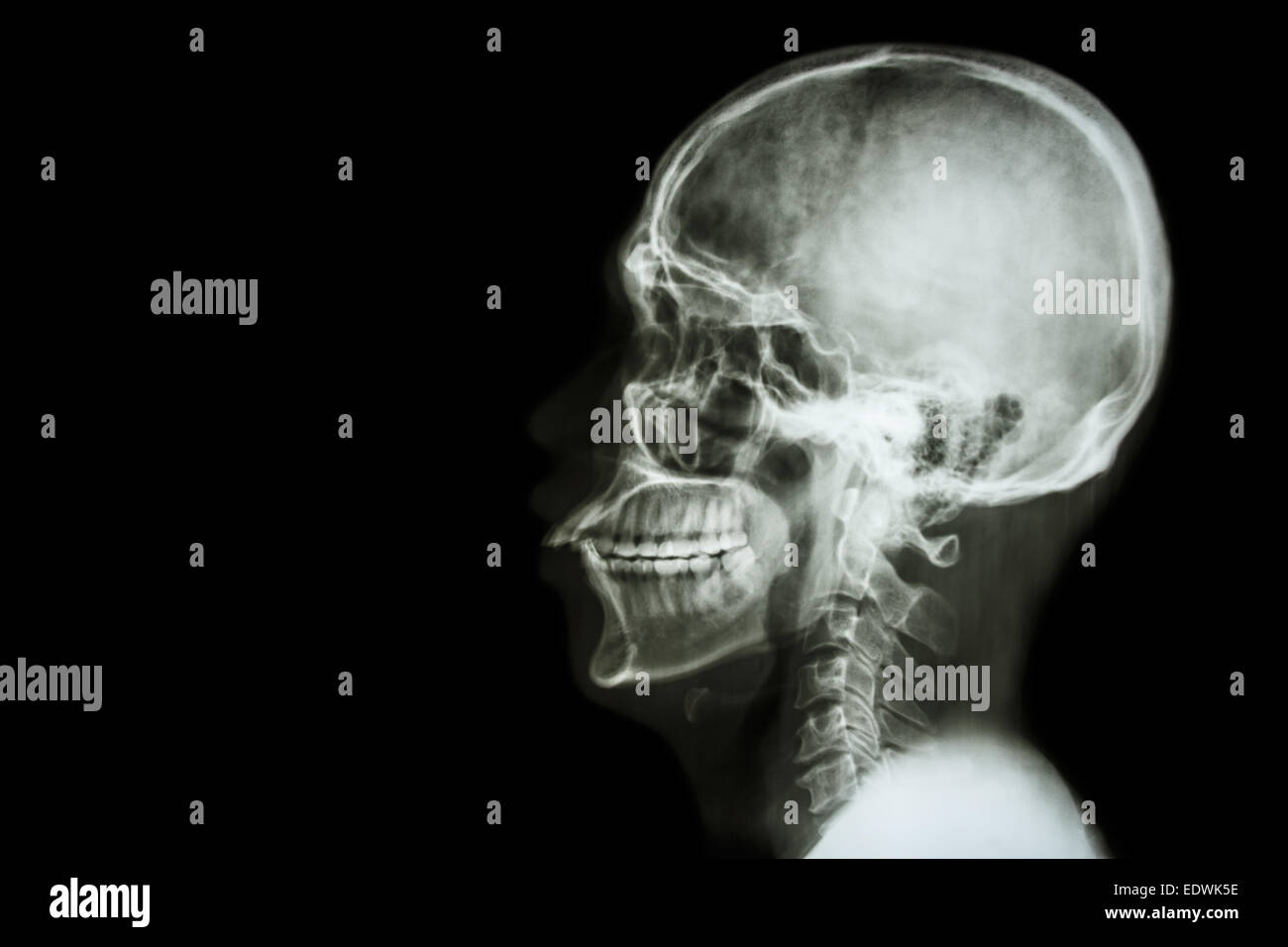 X-ray asiatischen Schädel und leeren Bereich auf der linken Seite Stockfoto