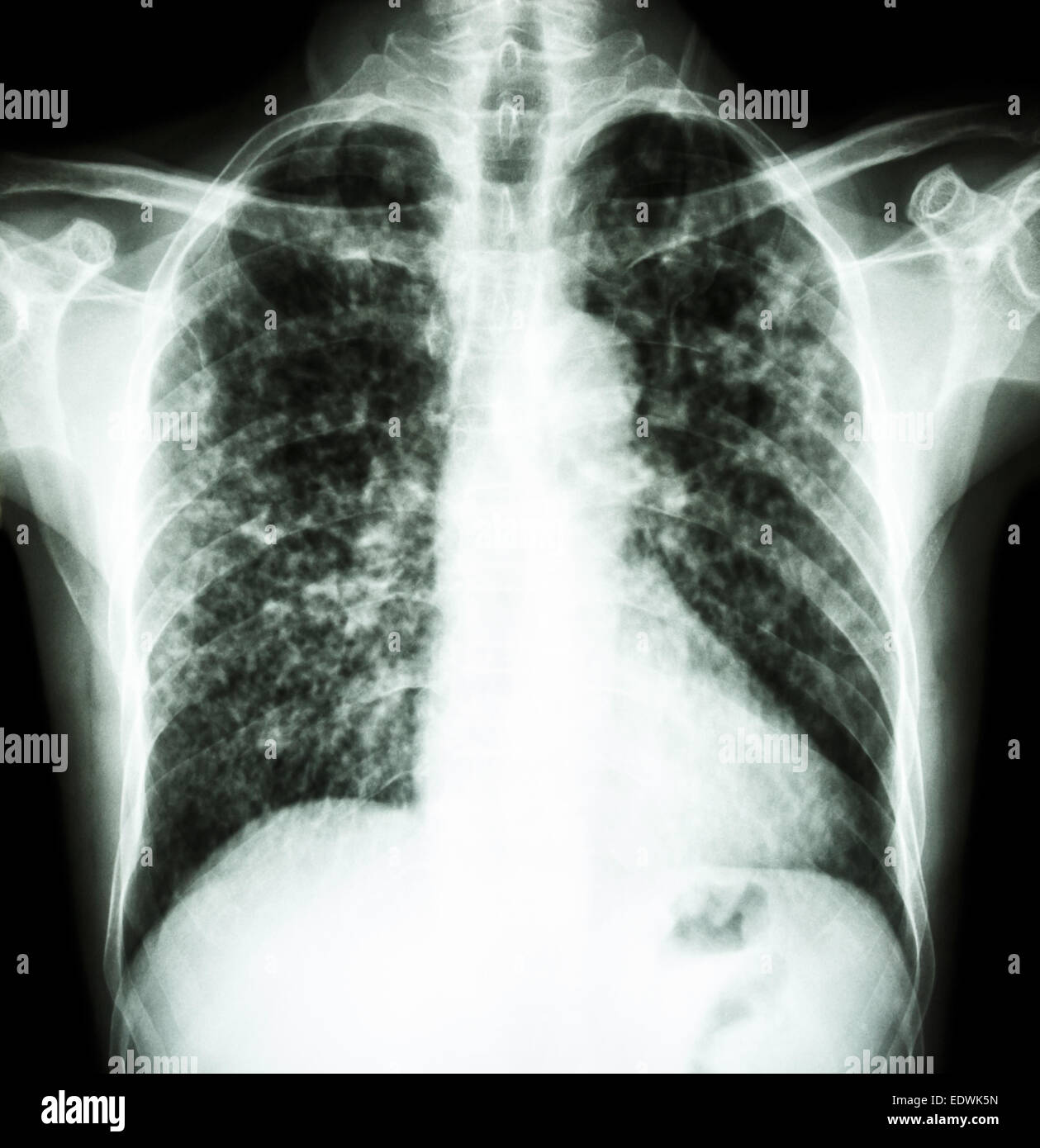 Röntgen der Film interstitielle Infiltrat zeigen beide Lungen durch