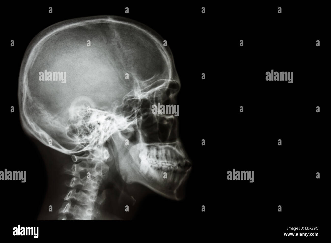 X-ray asiatischen Schädel (Thais) und leeren Bereich auf der rechten Seite Stockfoto