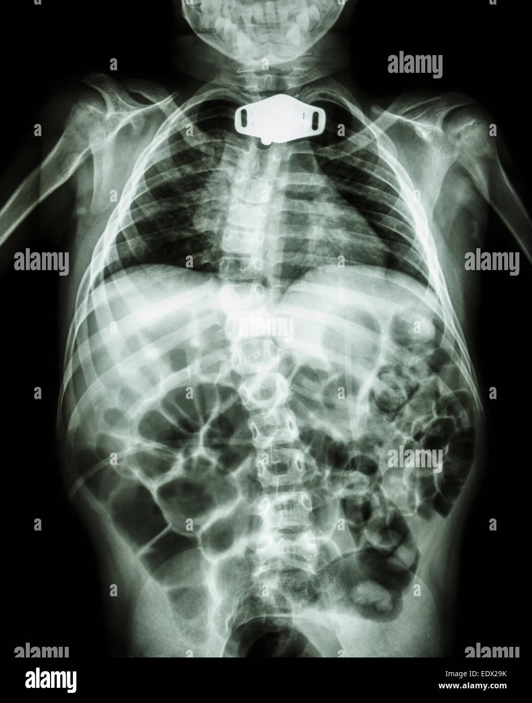 X-ray Körper von Kind und Tracheostoma Rohr im Halsbereich aufgrund respiratorischer Insuffizienz Stockfoto