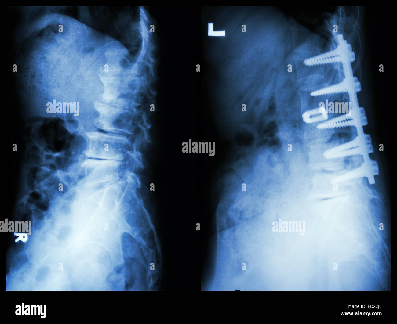"Spondylose" (linkes Bild), Patient wurde operiert und interne fixiert. (Rechtes Bild) in Greis Stockfoto