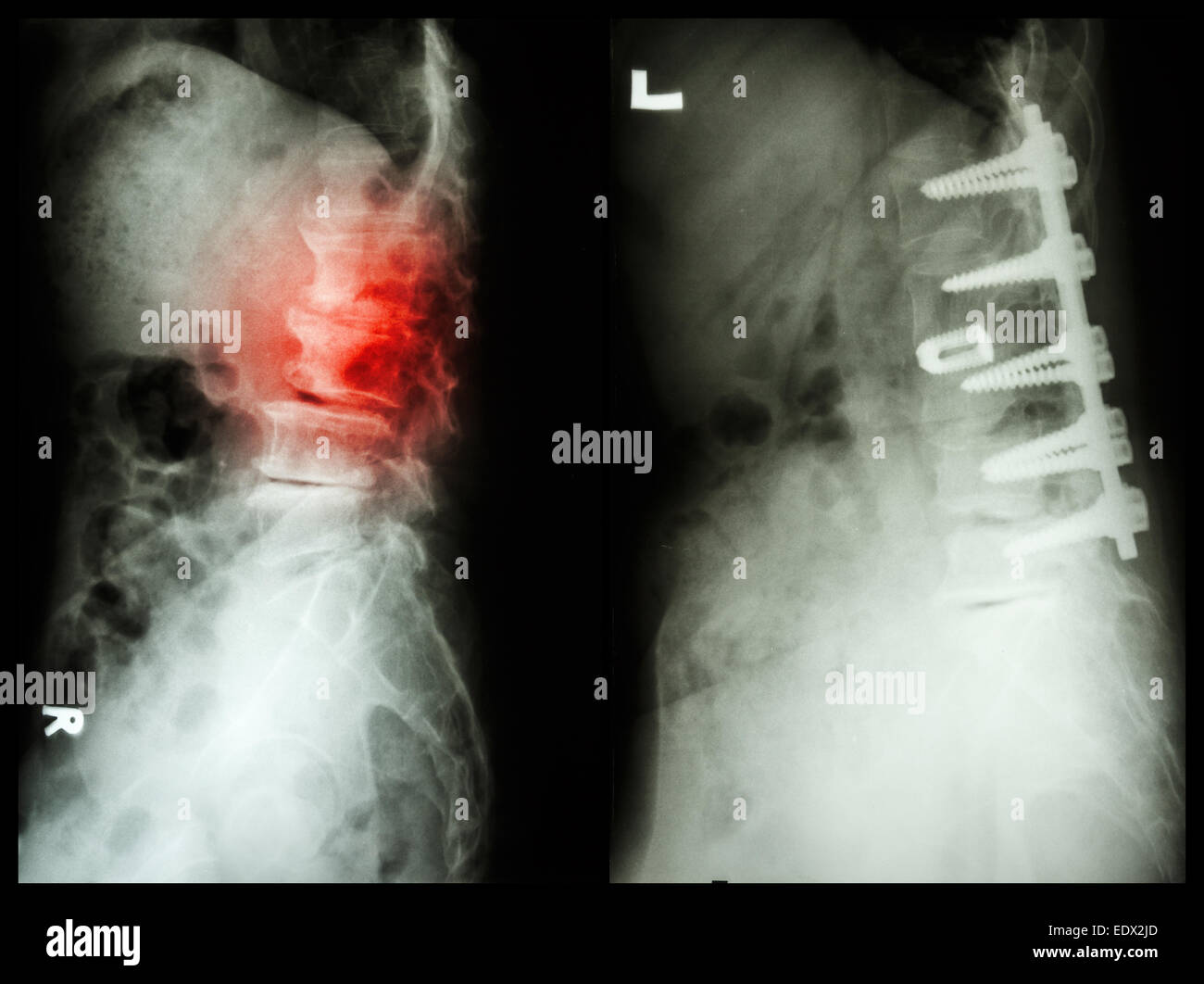 "Spondylose" (linkes Bild), Patient wurde operiert und interne fixiert. (Rechtes Bild) in Greis Stockfoto