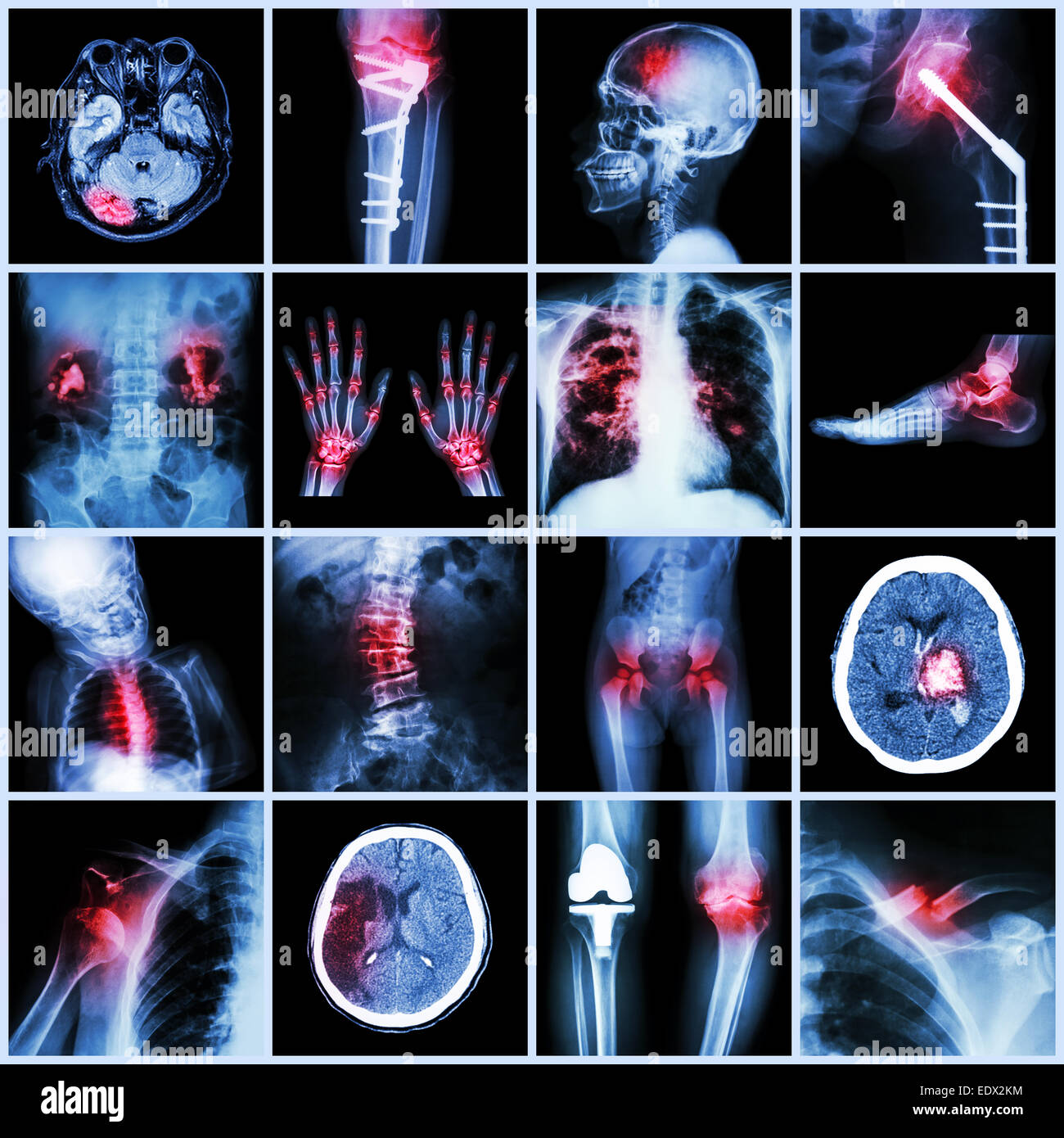 Eingestellt von x-ray mehrere Teil der menschlichen, mehrere Krankheiten, Orthopädie, Chirurgie (Schlaganfall, Knochenbrüchen, orthopädische Operation, Nierenstein, Stockfoto