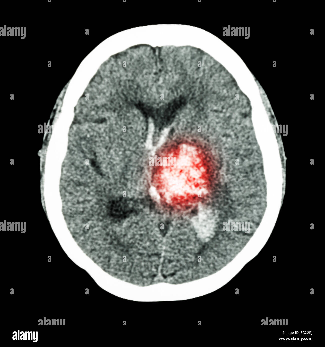 CT Gehirn: Show links Thalamische Blutung (hämorrhagischer Schlaganfall) Stockfoto