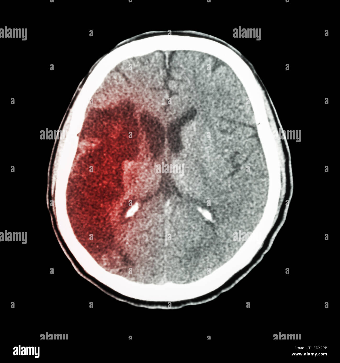 CT Gehirn: zeigen ischämischen Schlaganfall (Hypodensity bei direkt Frontal Parietallappen) Stockfoto