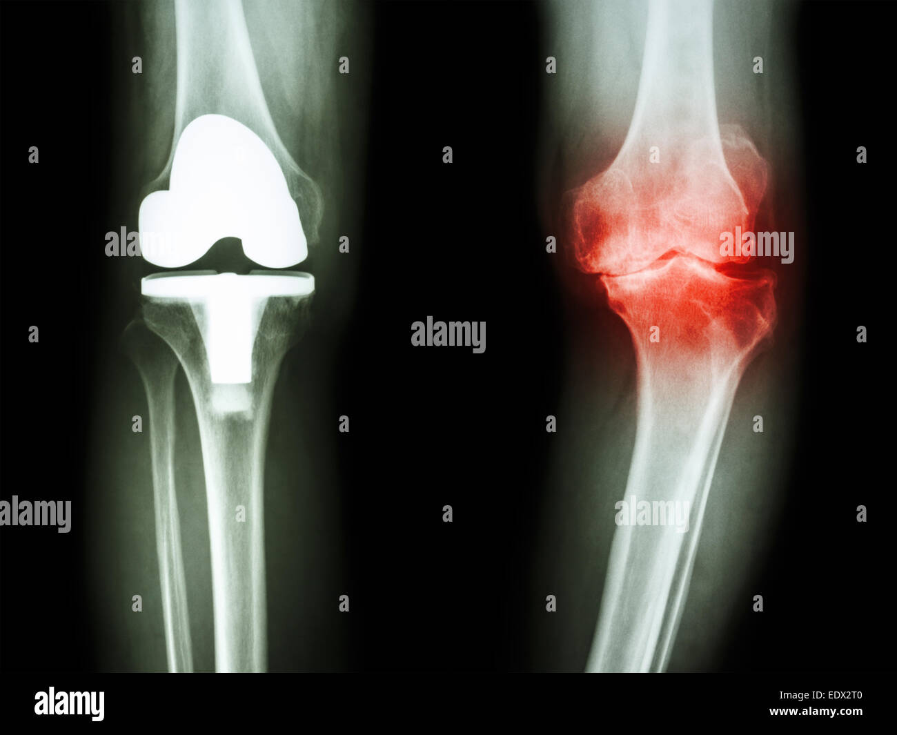 Film Röntgen Knie Arthrose Knie geduldig und künstlichen Gelenk Stockfoto