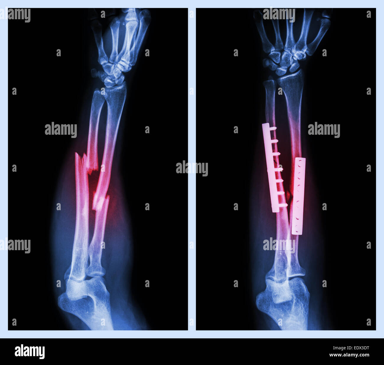 Fraktur beider Knochen des Unterarms. Es wurde operiert und interne mit Platte und Schraube fixiert (Bild links: vor der Inbetriebnahme, rechts Im Stockfoto