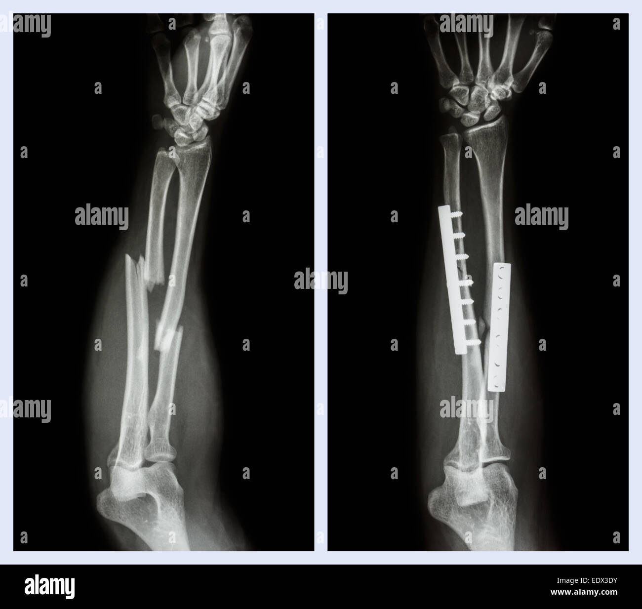 Fraktur beider Knochen des Unterarms. Es wurde operiert und interne fixiert mit Platte und Schraube (vor Inbetriebnahme, nach Operation) Stockfoto