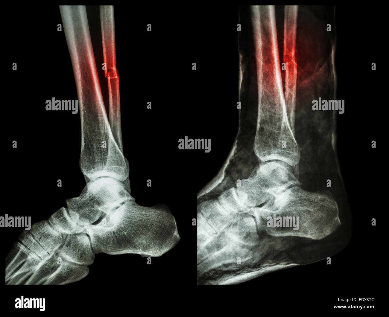 Bild links: Bruch der Welle der Fibula (Wadenbein), Bild rechts: es war verbunden mit Gipsverband Stockfoto