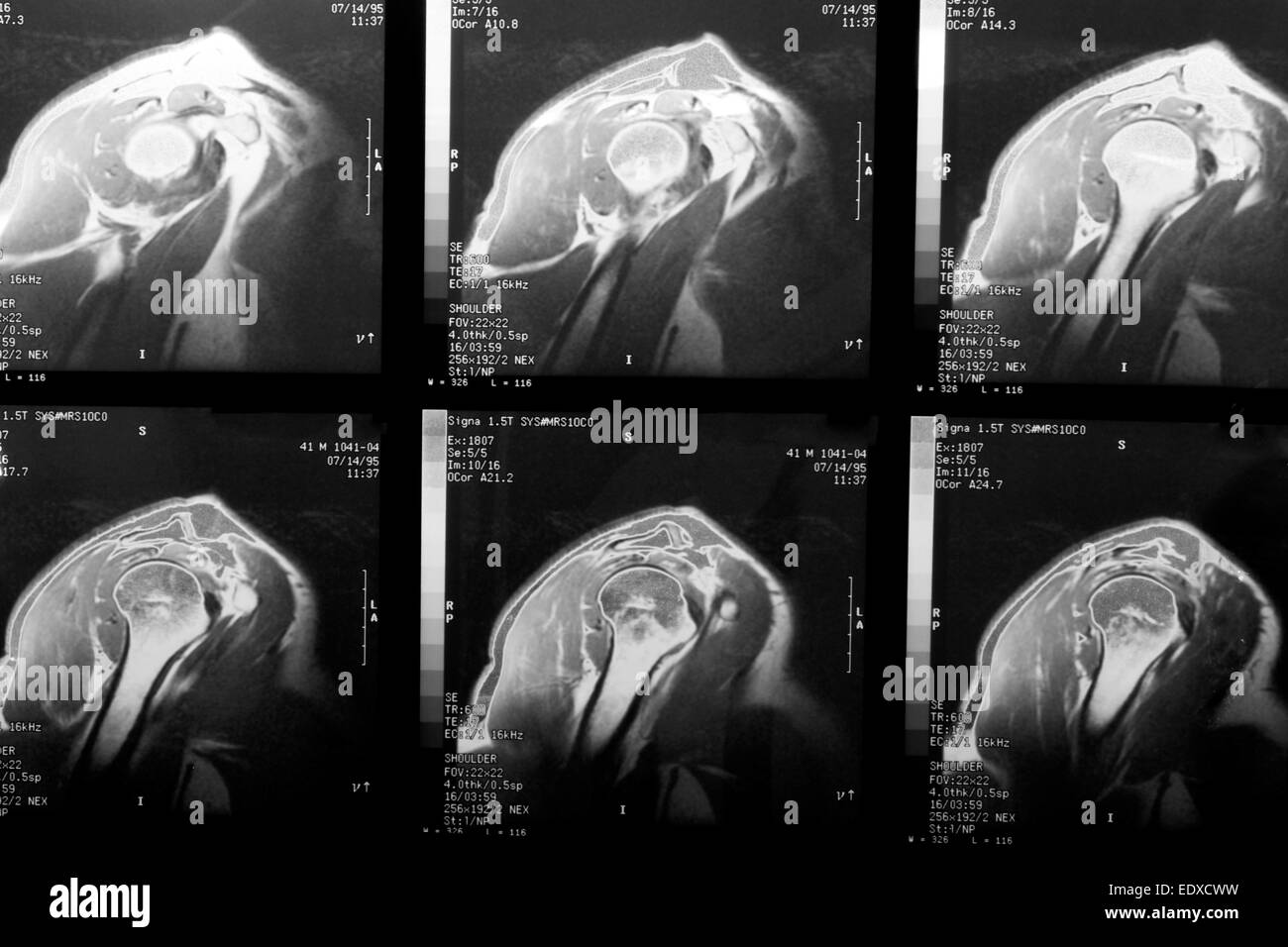 MRT-Aufnahmen von einem Schulterblatt und Rotatorenmanschette Stockfoto