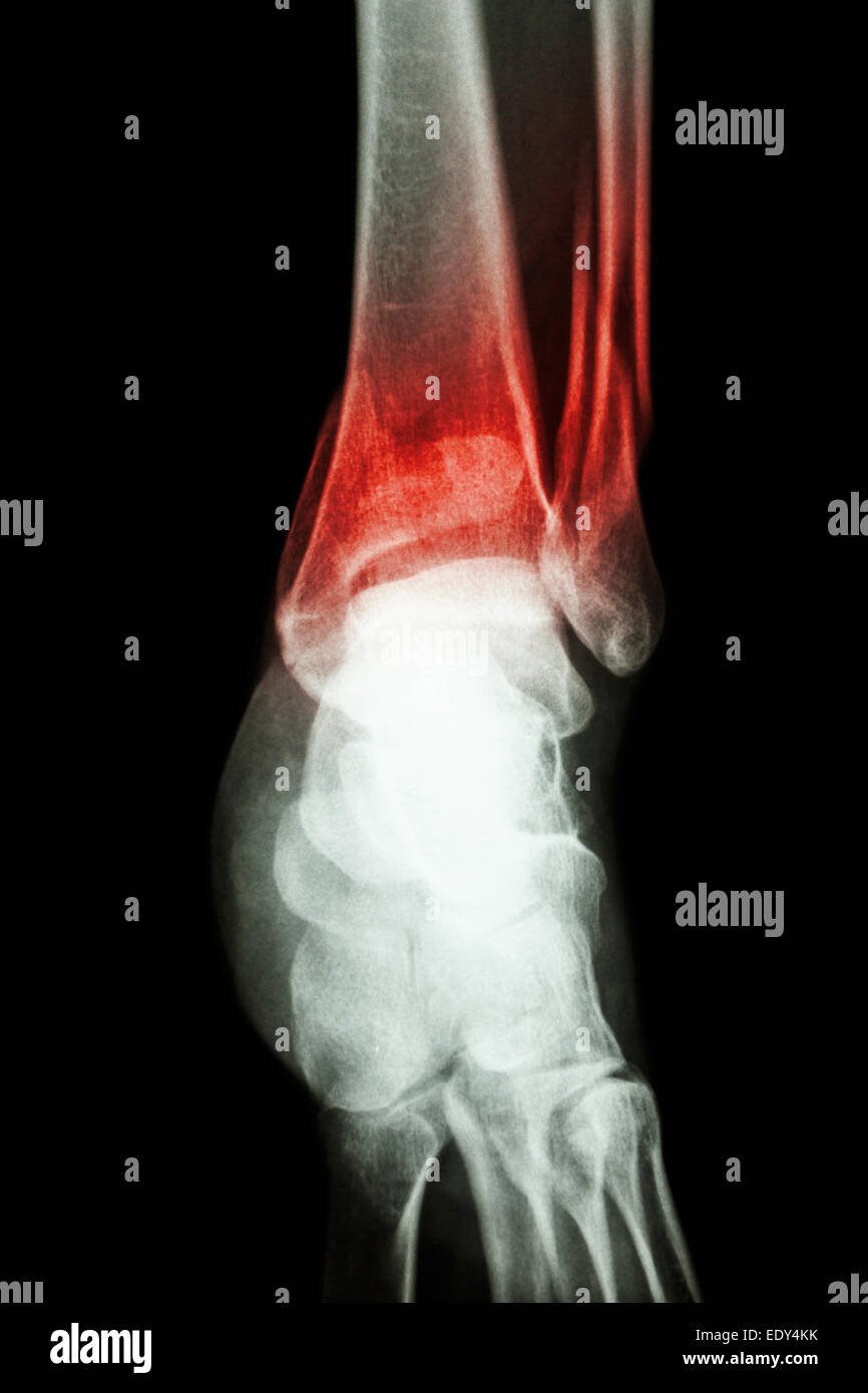 Film x-ray Knöchel zeigen Fraktur distale Tibia und Fibula (Beinknochen) Stockfoto