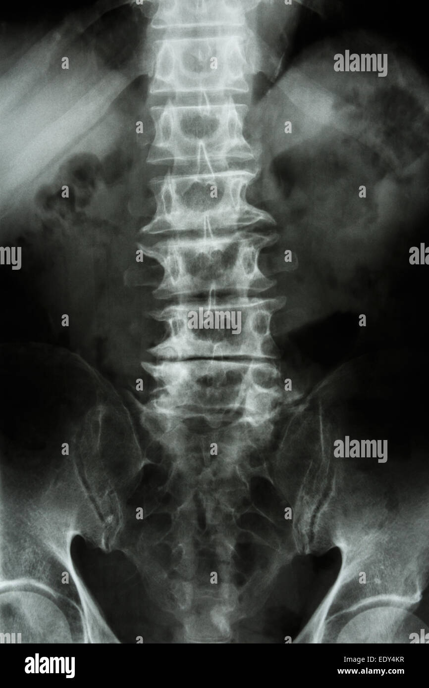 "Spondylose" Film Röntgen-L-S Wirbelsäule (Lenden-Kreuzbein) im Alter von der alten Patienten Stockfoto