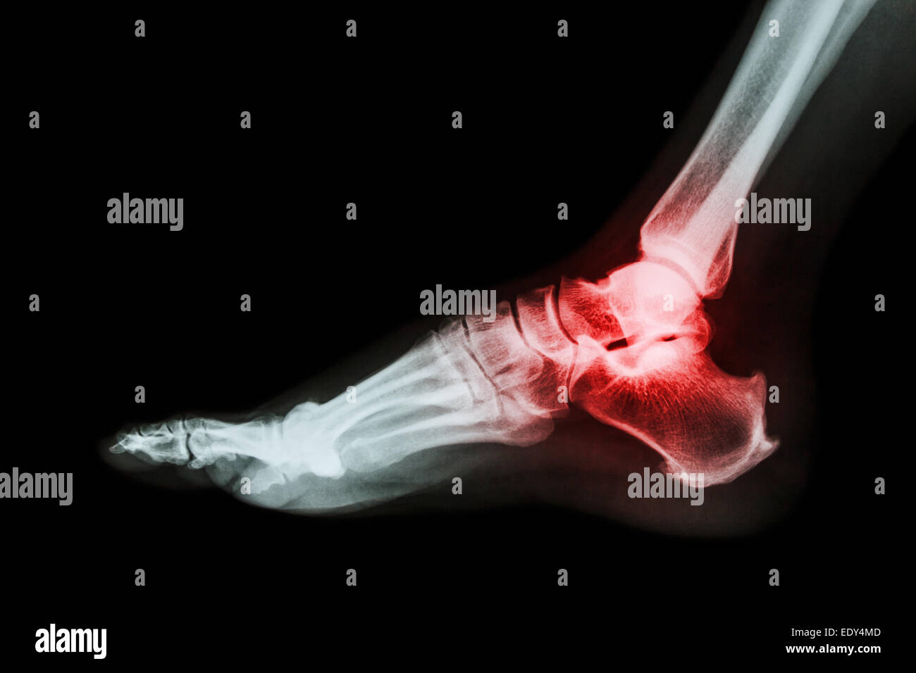 Arthritis im Sprunggelenk (Gicht, rheumatoide Arthritis) Stockfoto