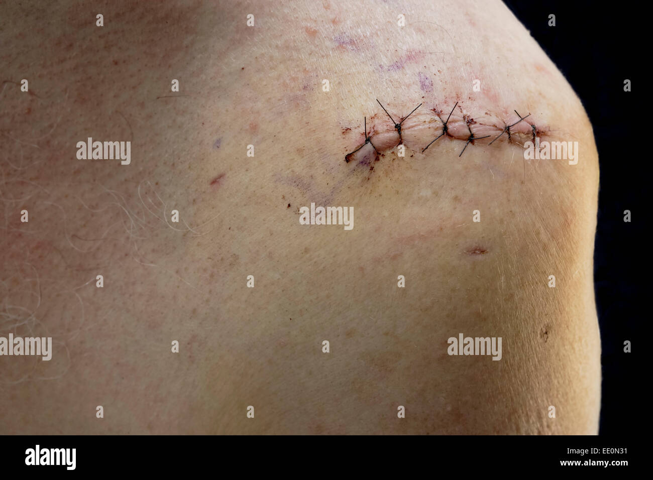 Chirurgischen Eingriff Wunde von Rotatorenmanschette Schulter Chirurgie-Victoria, British Columbia, Kanada. Hinweis-Digital composite Stockfoto
