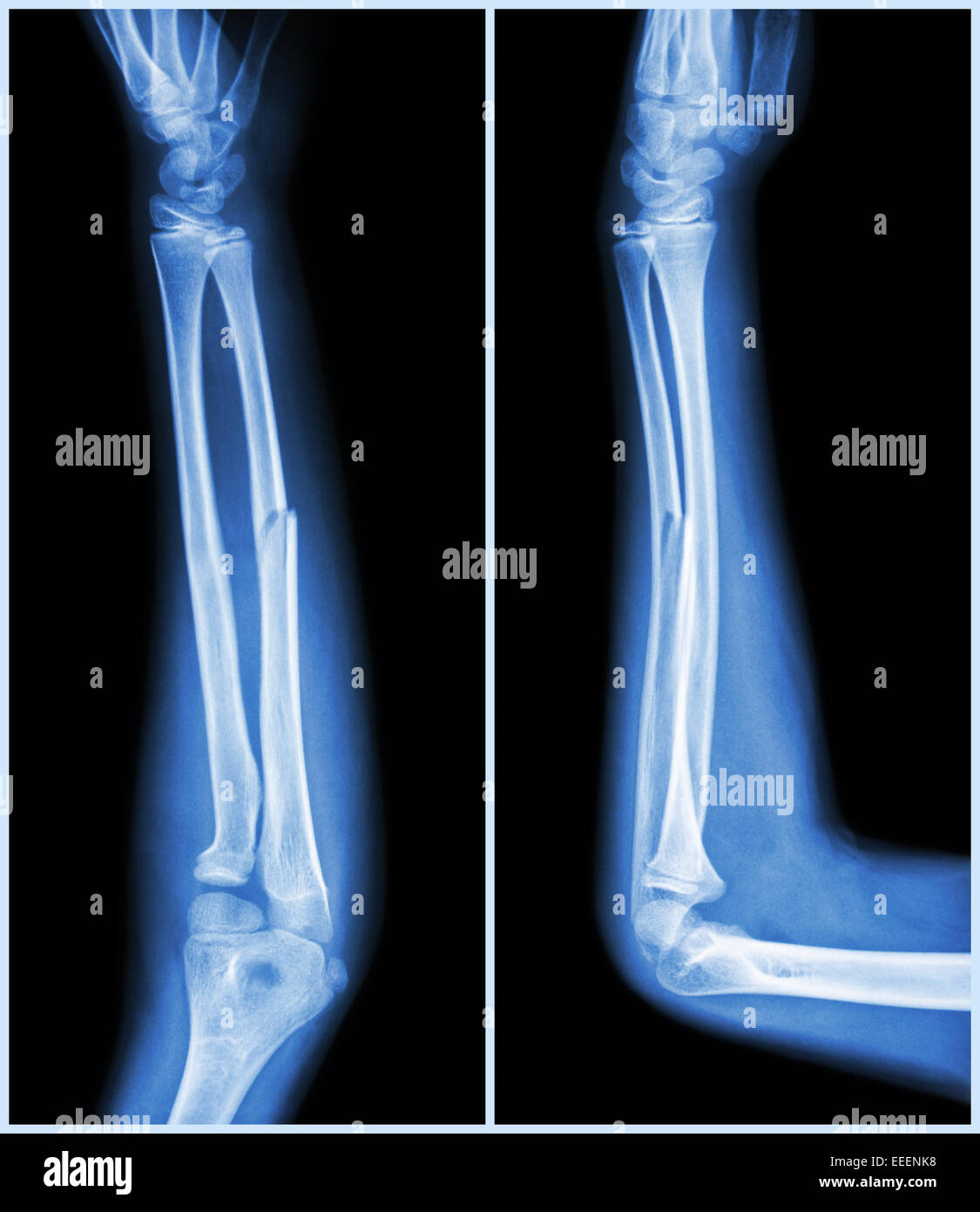 Fraktur-Schaft des ulnaren Bone (Unterarm-Bone): (Front und Seite anzeigen) Stockfoto