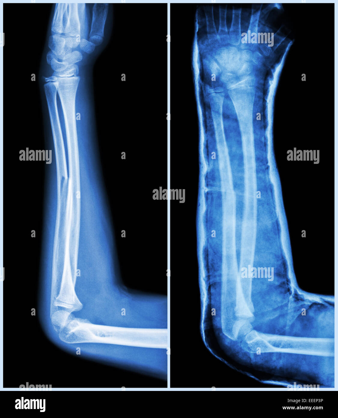 Fraktur-Schaft des ulnaren Bone (Unterarm-Bone): (links: Vorbehandlung, nicht wahr: Psot-Behandlung (Schiene mit Cast)) Stockfoto