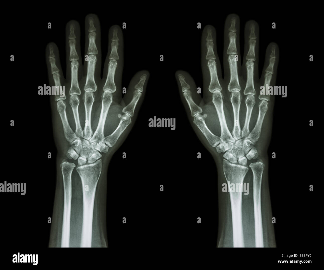Rontgenbild Einer Hand
