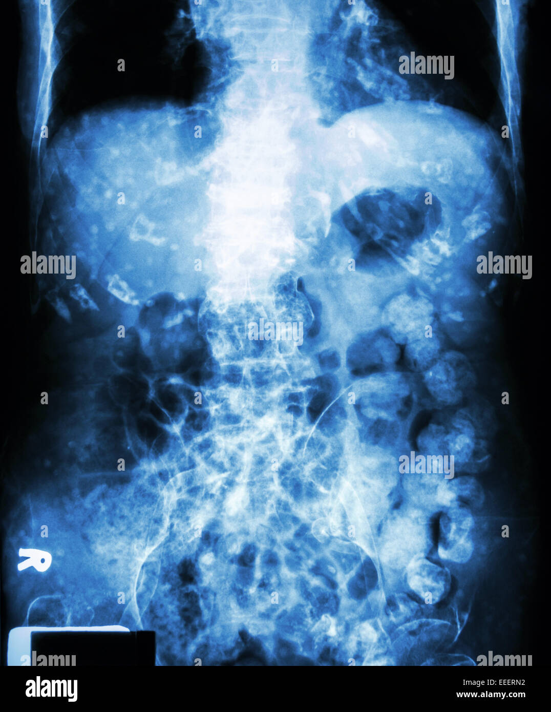 "Verstopfung" (Röntgen-Abdomen des alten Mannes: ein Großteil der Kot im Dickdarm und bei Rib verkalkt) Stockfoto