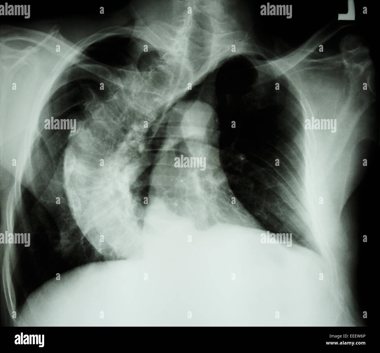 Skoliose (krumme Wirbelsäule) x-ray Brust von alten Menschen mit krummen Rücken Stockfoto