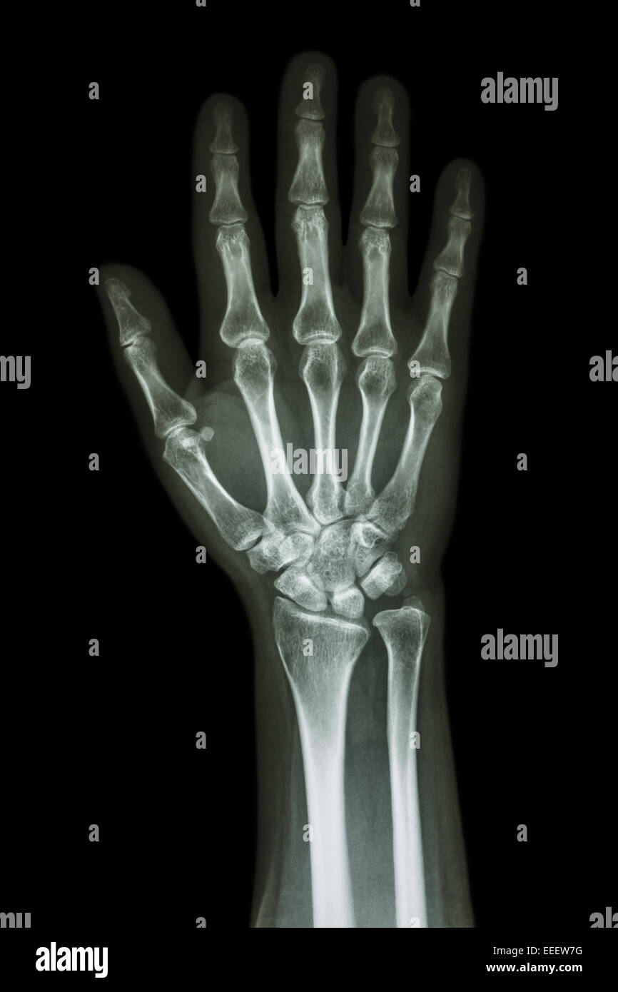 Normal X Ray The Hand Stockfotos & Normal X Ray The Hand Bilder Alamy