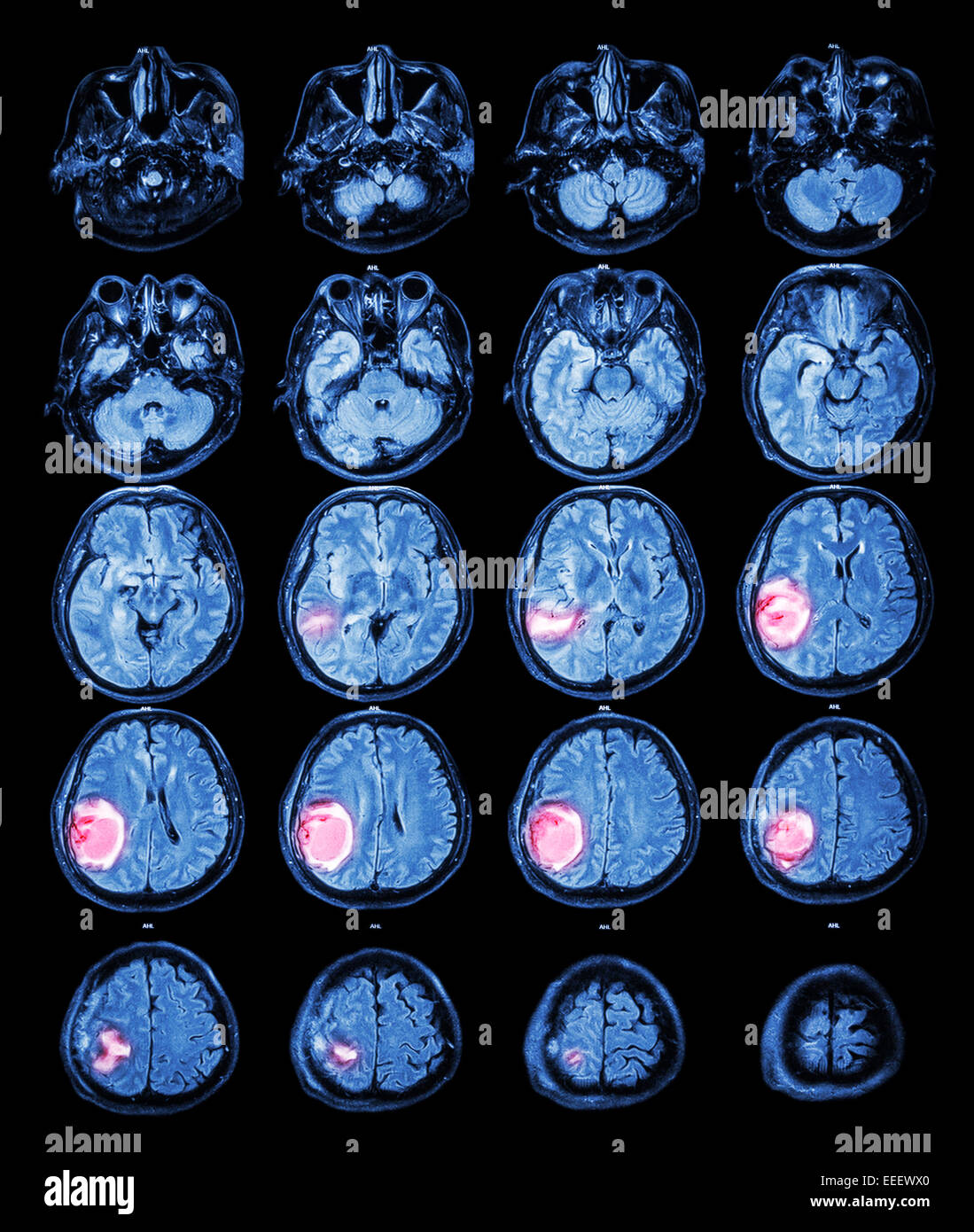 MRI Gehirn: Brain Tumor im rechten Scheitellappen Stockfoto