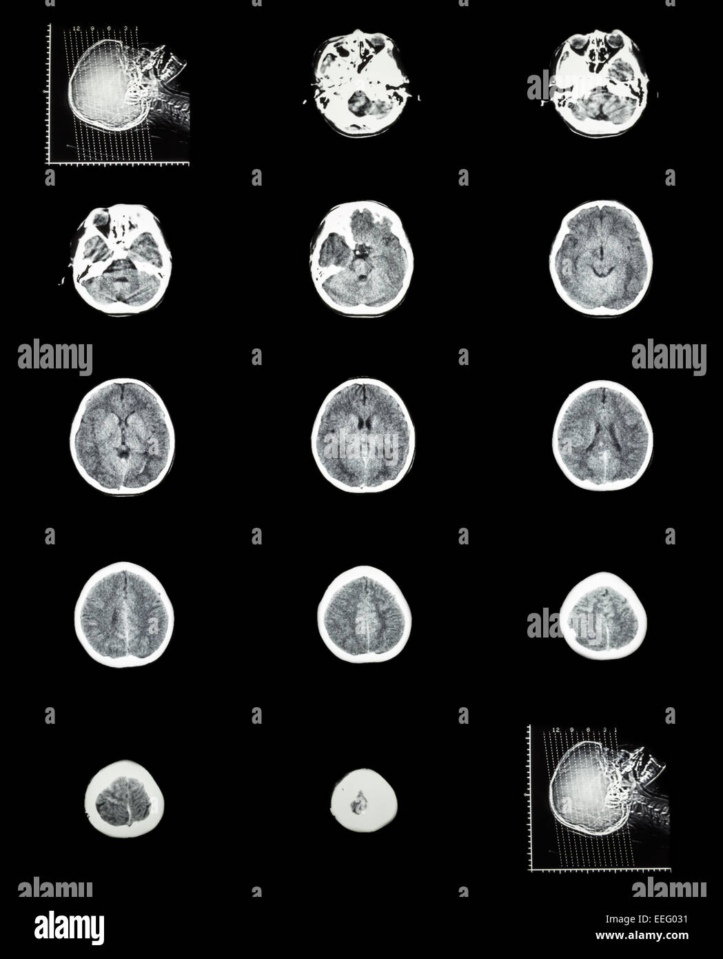 CT (Computertomographie) des normalen Gehirns (zerebrovaskuläre System) Stockfoto