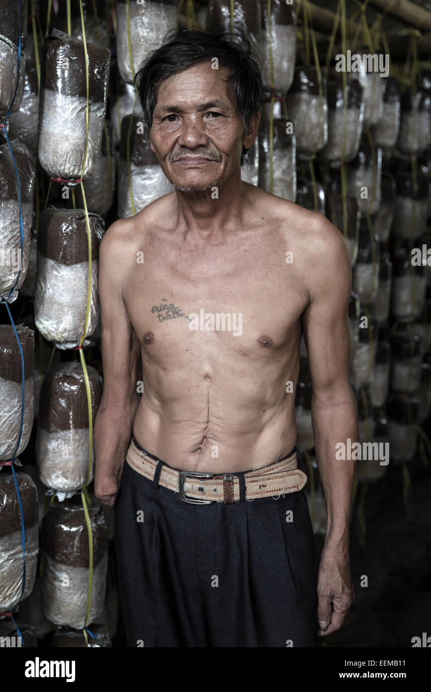 Nguyen Hinh ist ein Opfer von einem versteckten Sprengstoff seit dem Krieg. Stockfoto