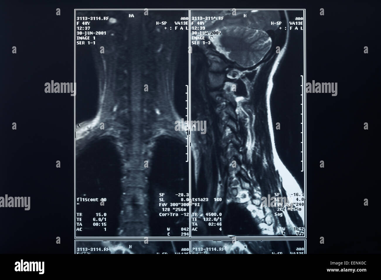 Wirbelsäule und Nacken Röntgen Röntgen Stockfoto