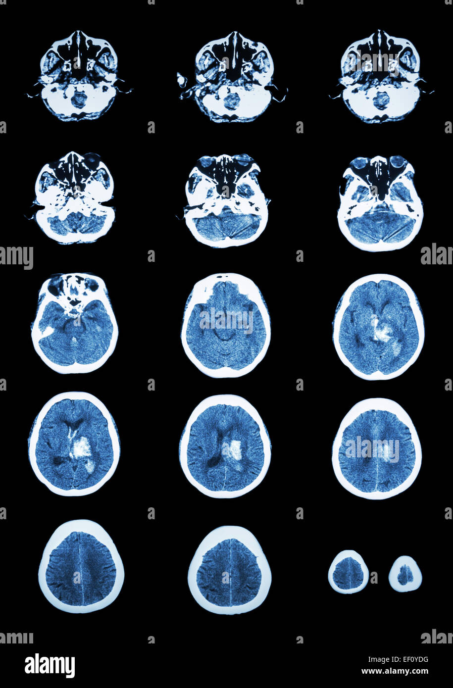 Hämorrhagischer Schlaganfall.  CT (Computertomographie) des Gehirns (zerebrovaskuläre System): Intrazerebrale Blutung am linken Cer Stockfoto