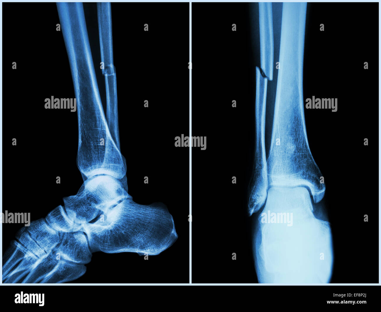 Fraktur-Schaft des Wadenbein (Fibula) Knochen (Knochen).  Röntgen des Beines (Position 2: Seiten- und Frontansicht) Stockfoto