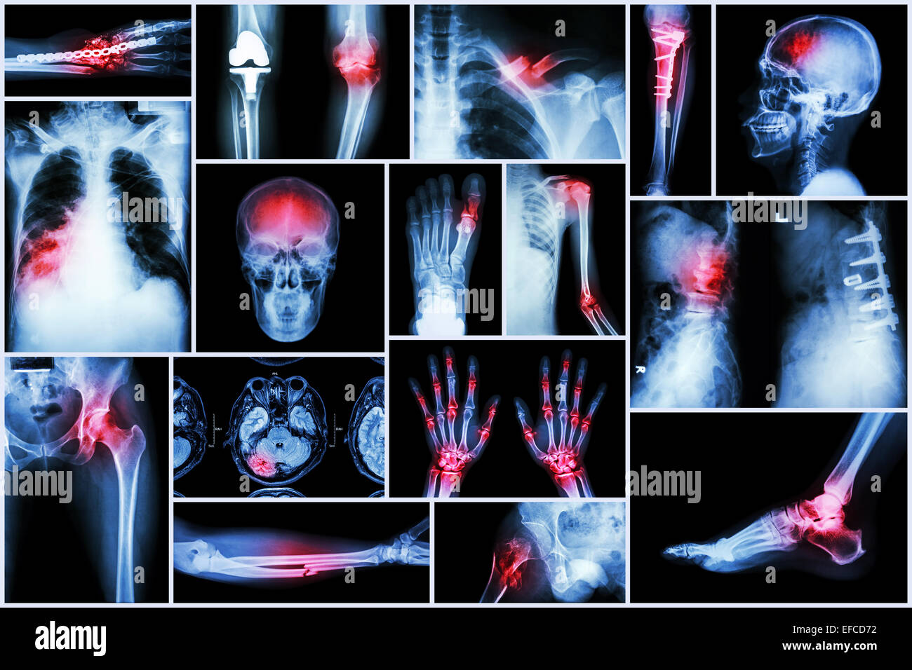 Kollektion Röntgen mehrere Krankheiten (Schlaganfall, Fraktur, Arthrose, Lungenentzündung, Tuberkulose, Spondylose, Spondylolisthesis, gehen Stockfoto