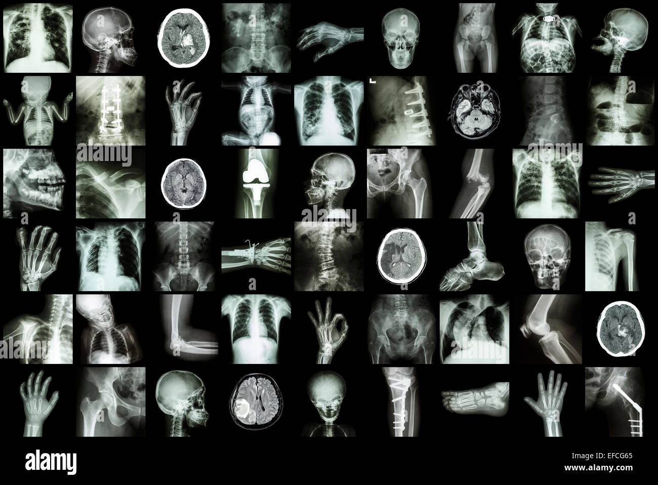 X-ray mehrere Teile von Erwachsenen und Kindern und Krankheit (Lungentuberkulose Schlaganfall Nierenstein Arthrose Knochen Fraktur Bogen Stockfoto