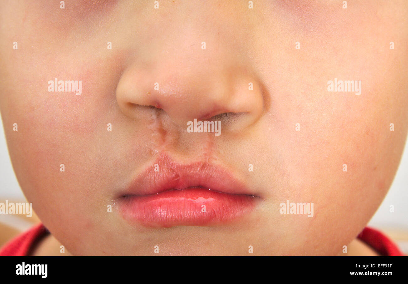 Jungen zeigen eine bilaterale Lippen-repariert Stockfoto
