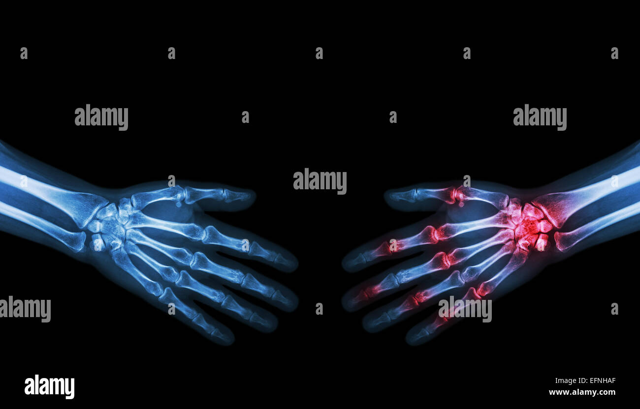 X-ray normaler Mensch ist mit Arthritis Hand Person Hand schütteln. Stockfoto